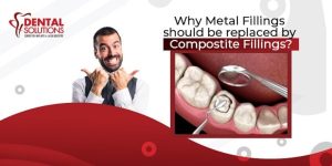 why-metal-fillings-should-be-replaced-with-composites