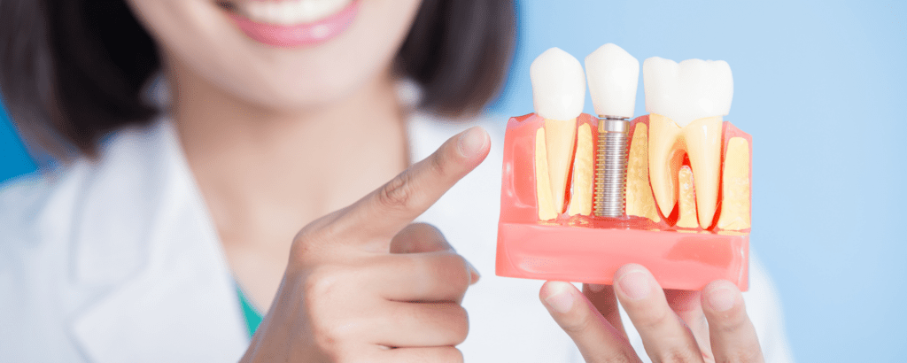 Dental Implants in Bangalore