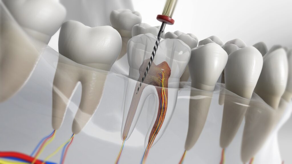 Root canal treatment in Bangalore