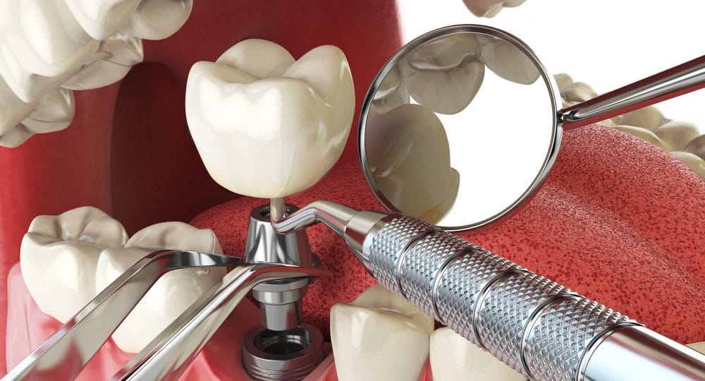 Best Implantologist in Bangalore