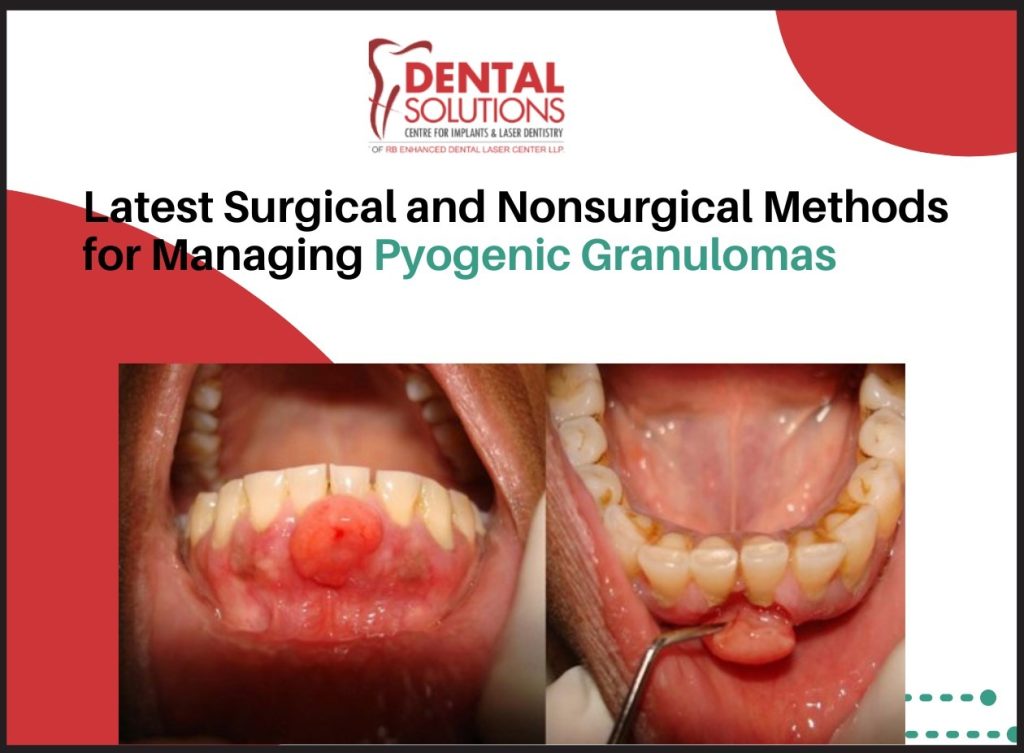 Treating Pyogenic Granulomas Safely Treating Pyogenic Granulomas Safely