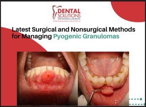 Pyogenic Granulomas
