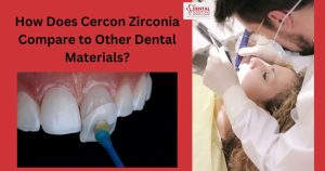 How Does Cercon Zirconia Compare to Other Dental Materials