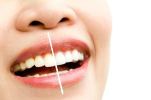 Why Do Teeth Turn Yellow Causes & Solutions