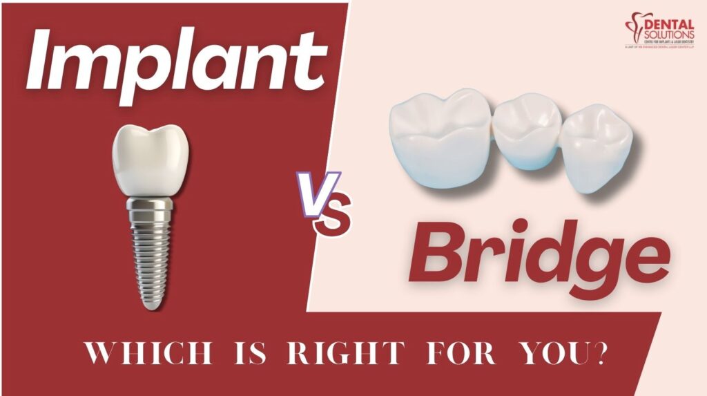 Comparison graphic showing a dental implant (screw and crown) versus a three-unit dental bridge, with the question 'Which is right for you?'