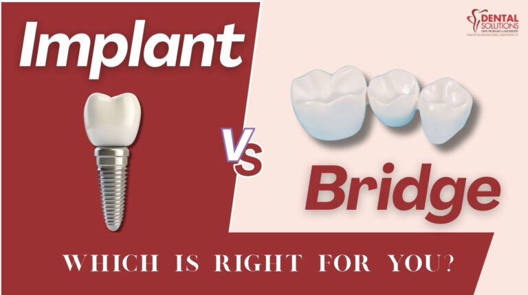 Comparison graphic showing a dental implant (screw and crown) versus a three-unit dental bridge, with the question 'Which is right for you?'