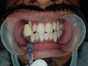 Before Procedure