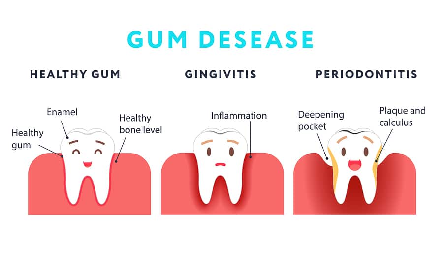 Common-questions-on-bleeding-gums