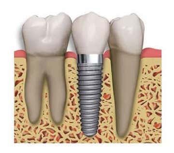 Endosteal-Implant