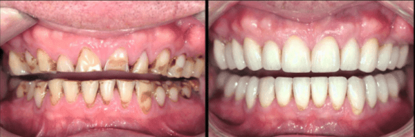 before and after full mouth rehabilitation
