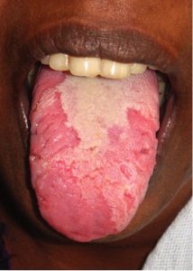Geographic-tongue