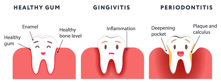 Gingivitis-stages