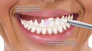 Laser-gingivectomy-procedure