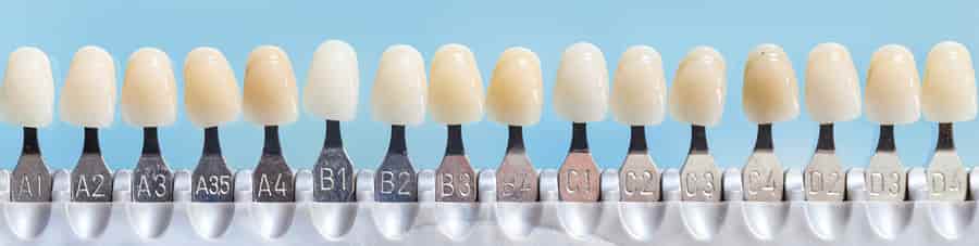 Porcelain-Veneers