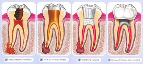 Single-Sitting-Root-Canal-Treatment
