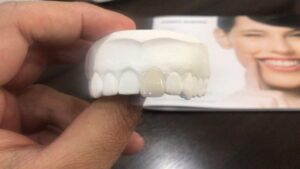 Tooth-injury1