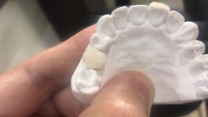 Tooth-injury3