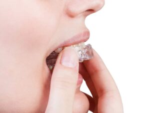Benefits Clear Aligners v/s Metal Braces