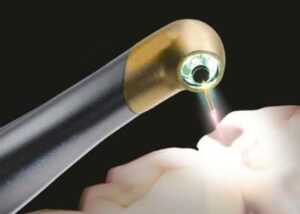 contactless-cavity-filling-using-er-yag-laser