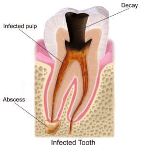 dental-abscess