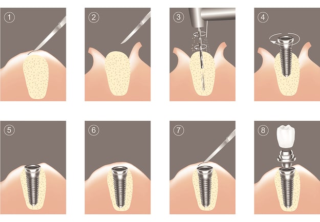 dental-implant-process