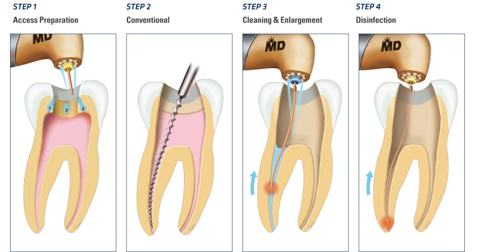 endo_steps
