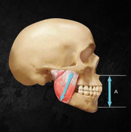full-mouth-restoration-vertical-dimension