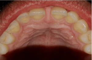 gap-between-front-teeth-high-frenum-attachment