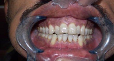 laser-gum-depigmentation-after