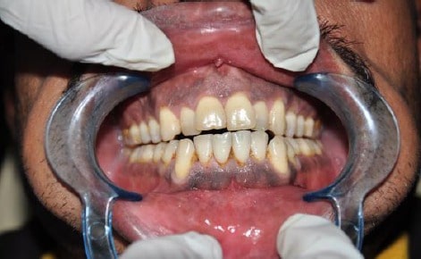 laser-gum-depigmentation-before