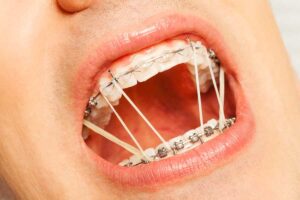 Advantages to clear aligners over traditional metal braces