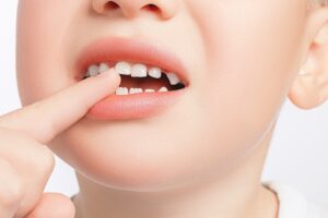 Correcting Overlapping Teeth