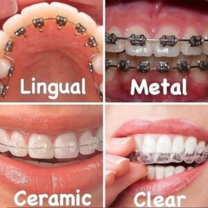 Causes of Overlapping Teeth