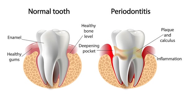 periodontitis-vs-healthy-tooth-min