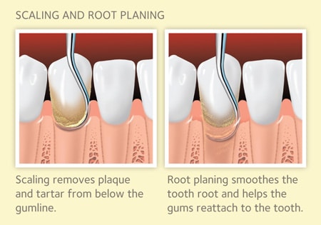 scaling-and-root-planing-procedure