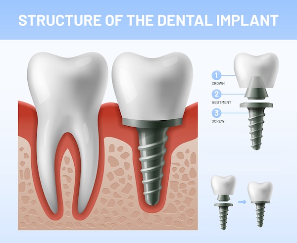 structure-of-the-dental-implant