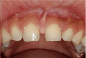 teeth-gap-high-frenum-attachment