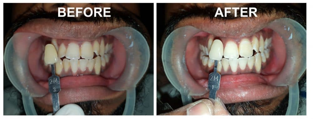 teeth-whitening-before-and-after-pictures