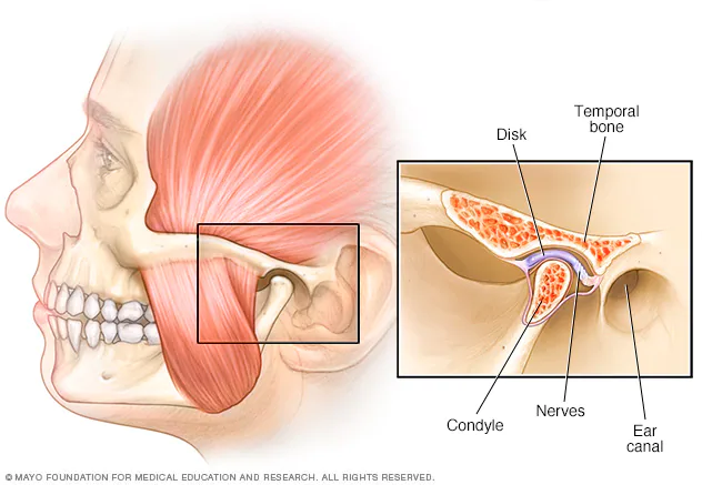 temporomandibular-joint-disorder-tmd