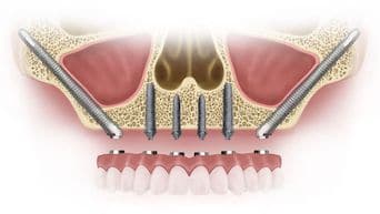 zygomatic-implant