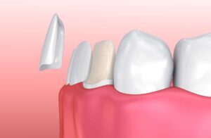 Dental-veneers