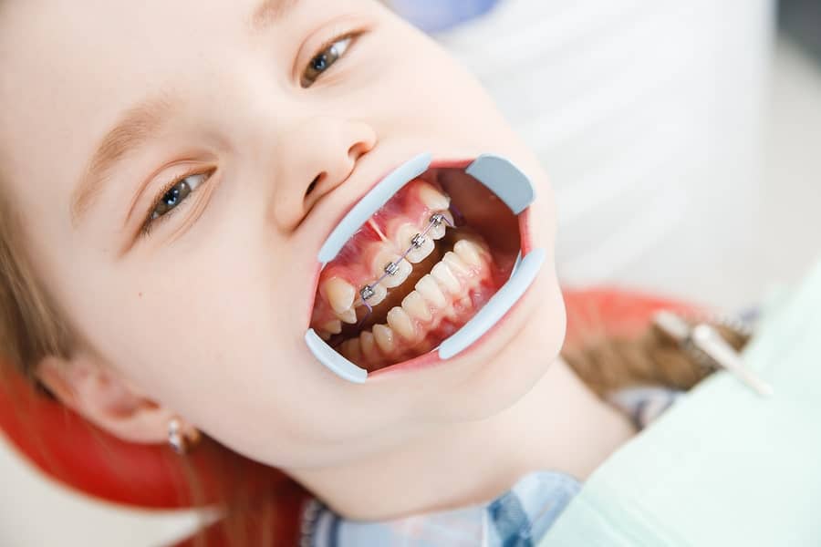 How-are-braces-fitted-in-children
