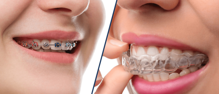 Invisalign vs. Metal Braces