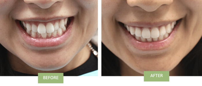 Transformation with Invisalign case 2