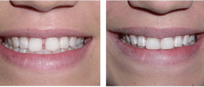 Transformation with Invisalign
