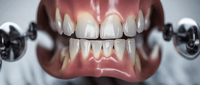 benefits of Invisalign