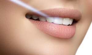 laser-whitening