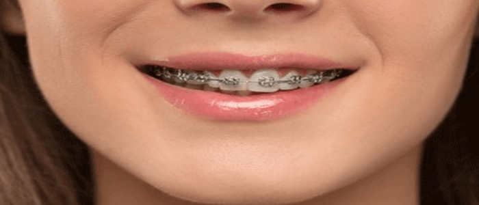 metal-braces