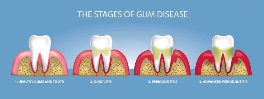 stages-of-gum-diseases