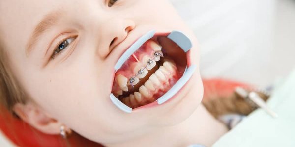 Child Dentistry in Bangalore